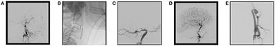 Treatment Methods and Early Neurologic Improvement After Endovascular Treatment of Tandem Occlusions in Acute Ischemic Stroke